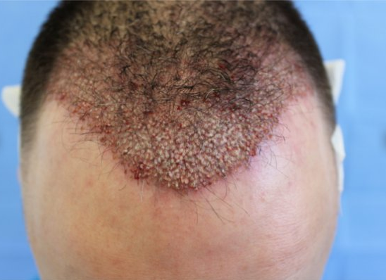 hair regrow after thyroid treatment